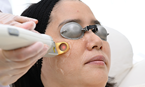 フォトフェイシャル(IPL/光)エクセルフェイシャル